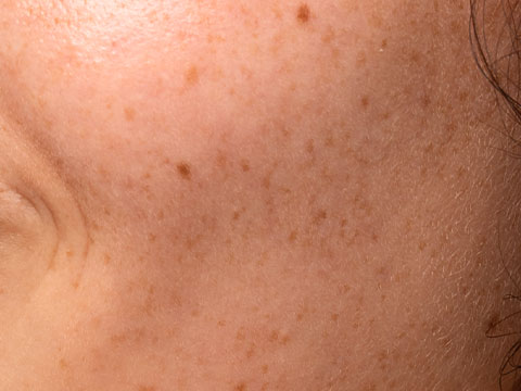 Dark Spots & Pigmentation