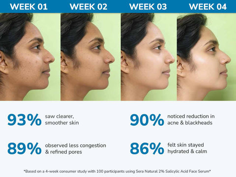 2% Salicylic Acid Face Serum with Hyaluronic Acid & Cucumis Extract